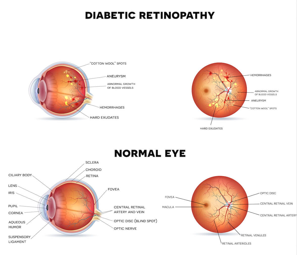 Retina Raleigh, Diabetic Retinopathy Raleigh